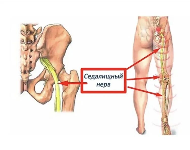 Как определить защемление нерва. Седалищный нерв схема. седалищный нерв схема расположения. седалищный нерв анатомия схема. защемление седалищного нерва.