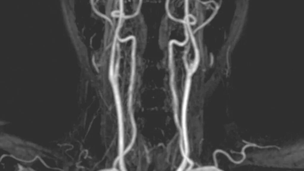 Магнитно-резонансная ангиография сосудов шеи. Атеросклероз сосудов на мрт ангиография сосудов. Кт ангиография сосудов шеи. ВСА анатомия мрт.