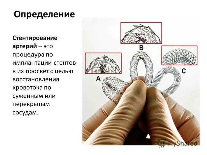 Стентирование прогнозы