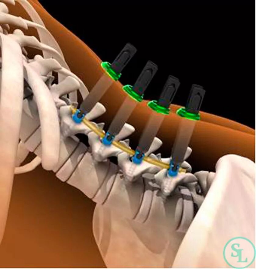 Транспедикулярная фиксация поясничного отдела. Операция транспедикулярная фиксация позвоночника. Кейдж Capstone межтеловой поясничный. Спондилодез Кейджем шейного отдела. Конструкция позвоночника операция