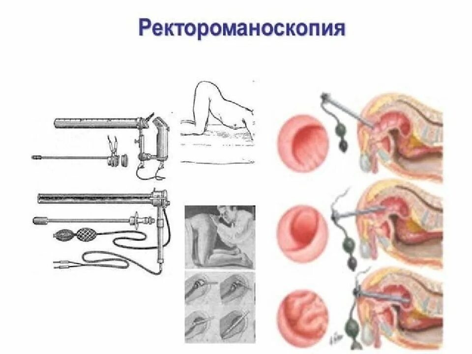 Прямая кишка ррс. Прямая кишка ректороманоскопия. исследование прямой кишки ректороманоскопия. ректороманоскопия это метод исследования. ректоскопия техника проведения.