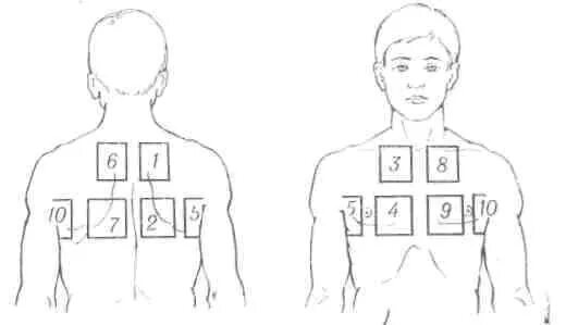 Сколько держать горчичники на спине. Постановка горчичников на грудную клетку при кашле. Постановка горчичников при бронхите. Схема постановки горчичников при кашле. Схема горчичников при бронхите.