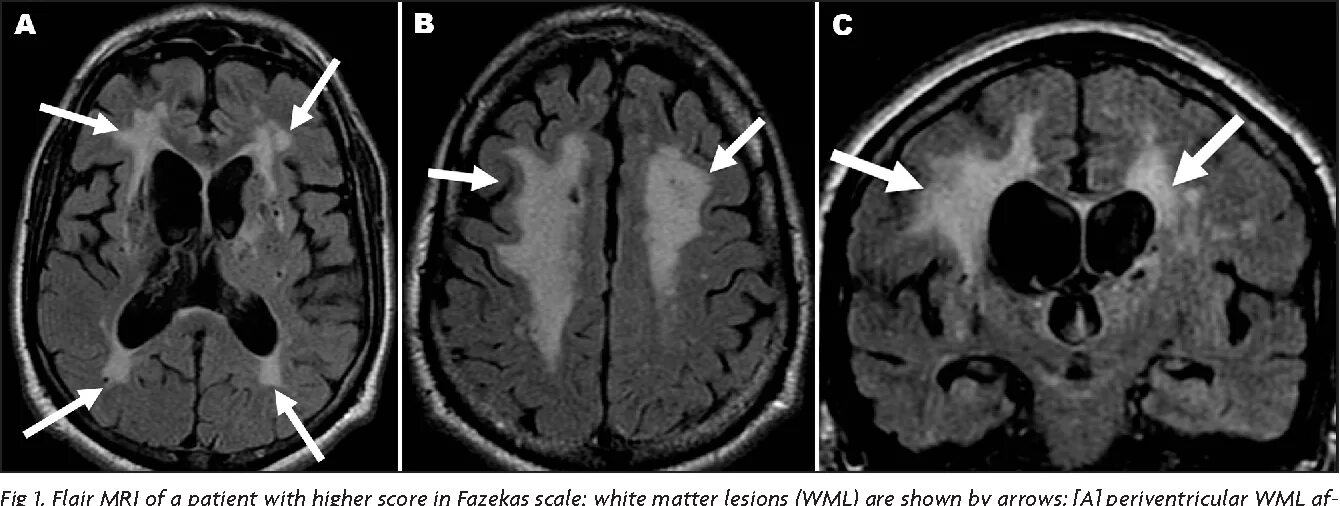 Микроангиопатия головного мозга fazekas. Перивентрикулярный лейкоареоз на кт. Лейкоареоз головного мозга на кт. Лейкоареоз Фазекас. Фазекас мрт.