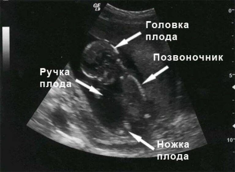 14 недель триместр. Как выглядит плод в 14 недель на УЗИ. УЗИ плода на 14 неделе беременности. УЗИ 13-14 недель беременности. Фото УЗИ 13-14 недель беременности.