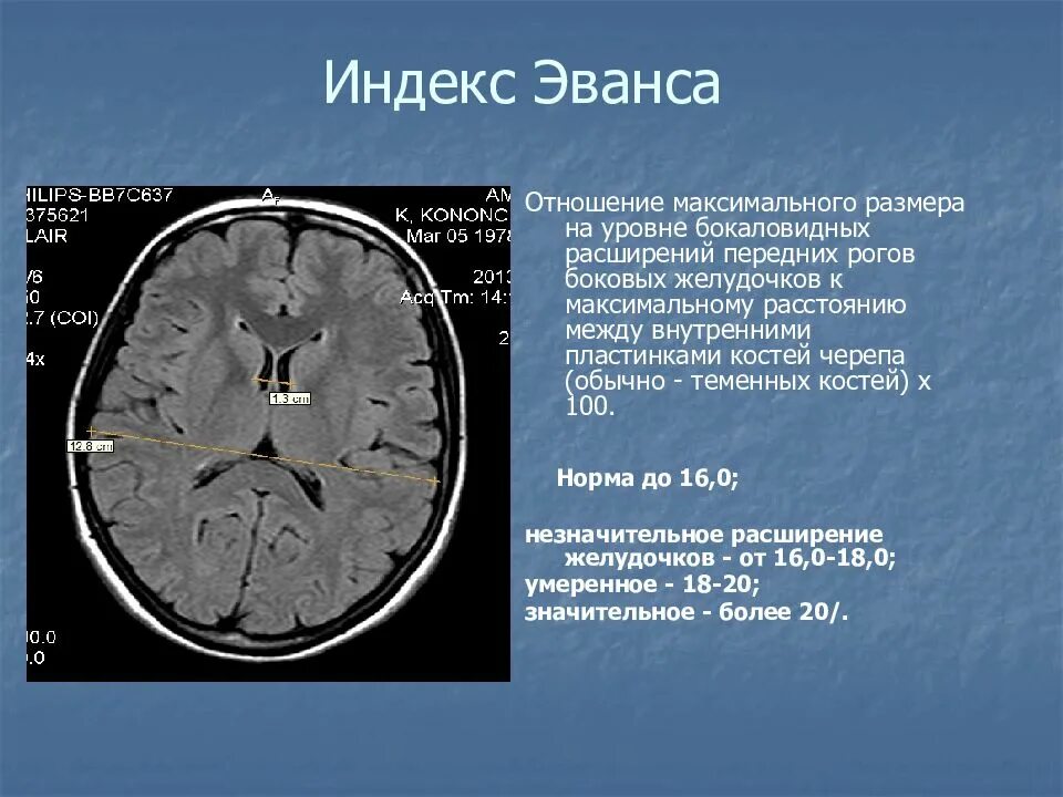 Расширение боковых рогов