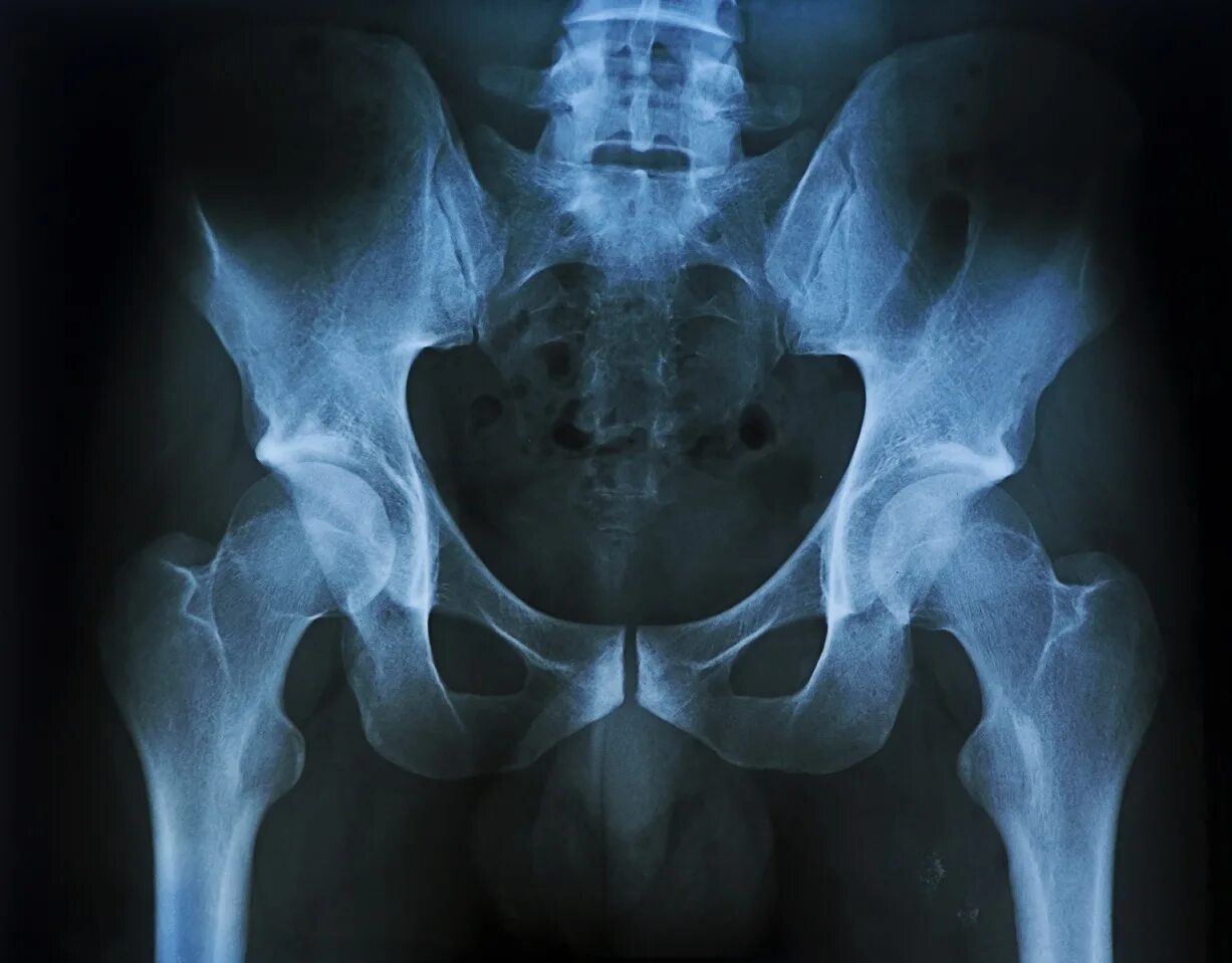 Перелом костей таза рентгенограмма. Перелом костей таза рентген. Рентген таза перелом Лоновой кости. Перелом лонной кости рентгенограмма.