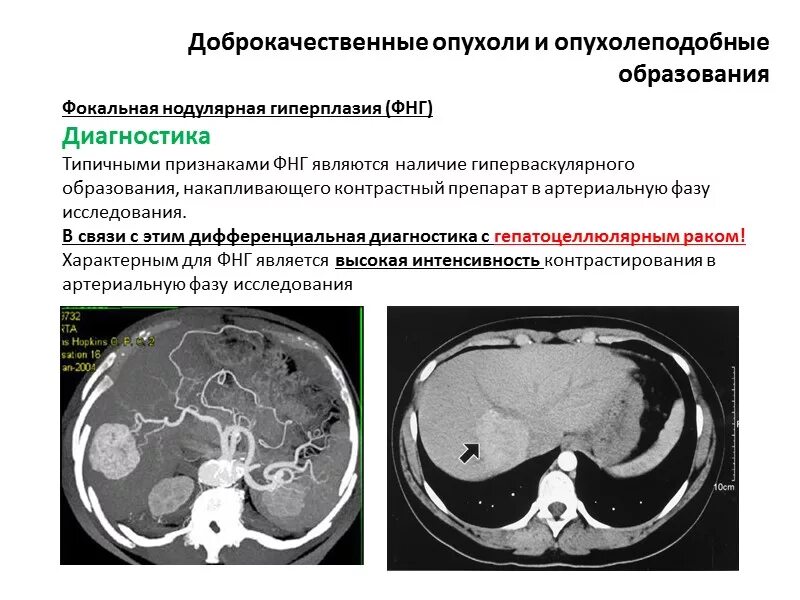 Гиперваскулярные образования печени на кт. Фокальная Узловая гиперплазия печени кт. Очаговая Узловая гиперплазия печени на мрт. Очаговая Узловая гиперплазия печени кт. Локальное опухоль