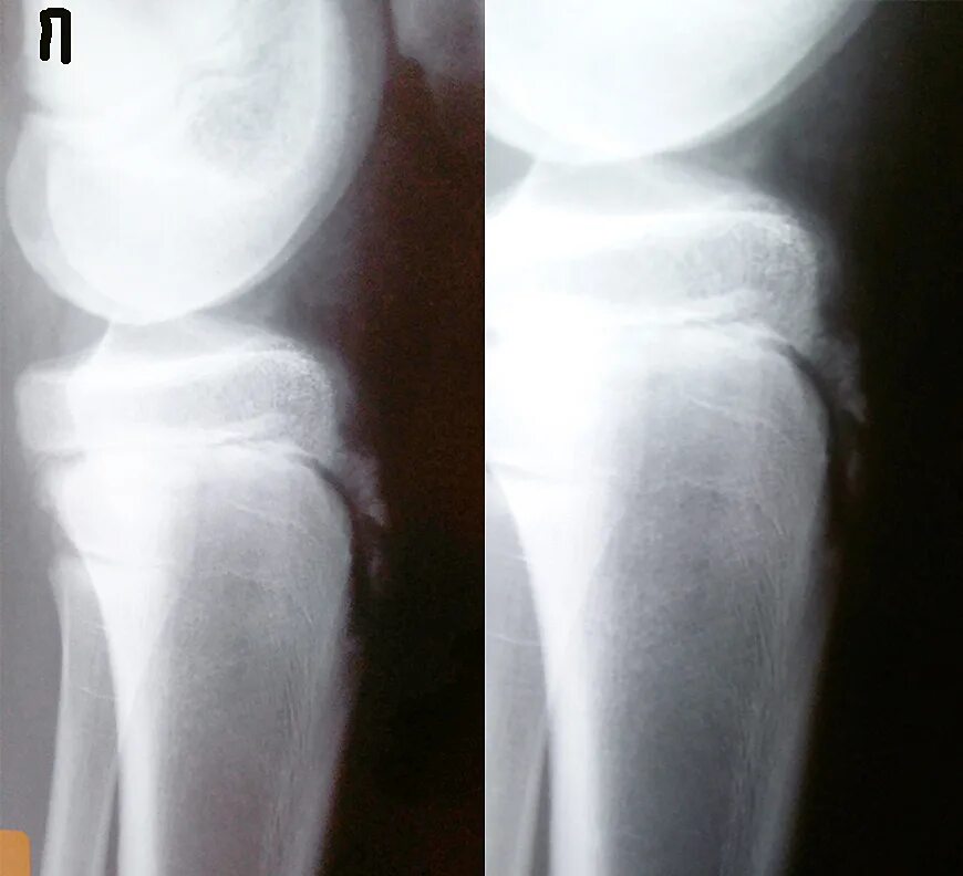 Шляттера мкб 10. Осгуд Шляттера болезнь. Осгуд Шляттера рентген. Осгуда-Шлаттера рентген. Болезнь Шляттера коленного сустава.
