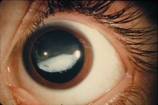 Эндофтальмит роговица. Глаза катаракта глаукома. Закрытоугольная глаукома глаза.