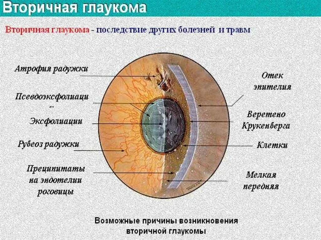 Вторичной открытоугольной глаукомы.. Вторичная увеальная глаукома. Причины вторичной глаукомы. Вторичная посттравматическая глаукома. Причины глаукомы глаза