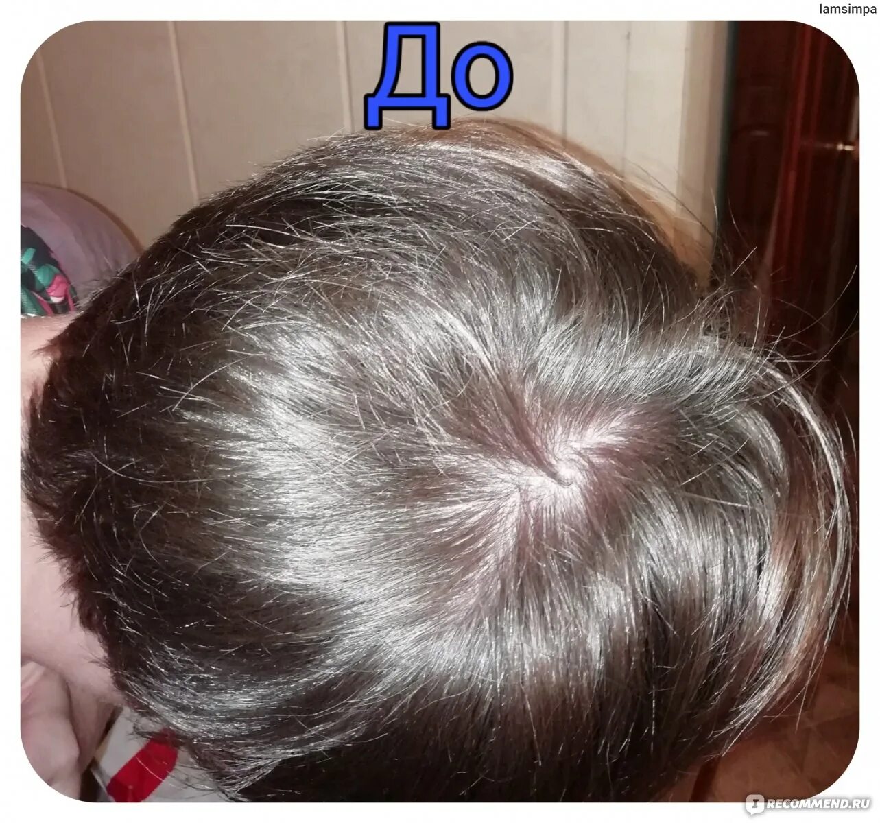 Пробуждение волосяных луковиц. Лекарства для пробуждения волосяных луковиц. Для пробуждения волосяных луковиц на голове. Пробуждение волосяных луковиц. Препарат для пробуждения спящих волосяных луковиц.