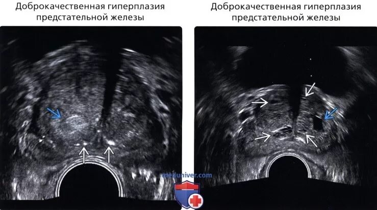 Очаг в предстательной железе