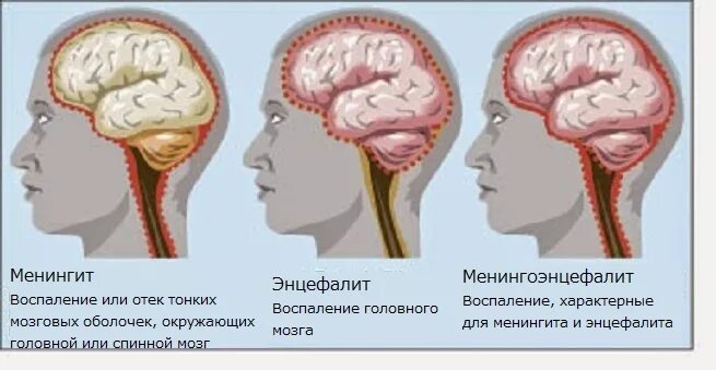 Менингит энцефалит и менингоэнцефалит. Менингит и менингоэнцефалит разница. Менингококковая инфекция у детей менингоэнцефалит. Менингоэнцефалит, воспаление головного мозга. Воспаление головного мозга латынь