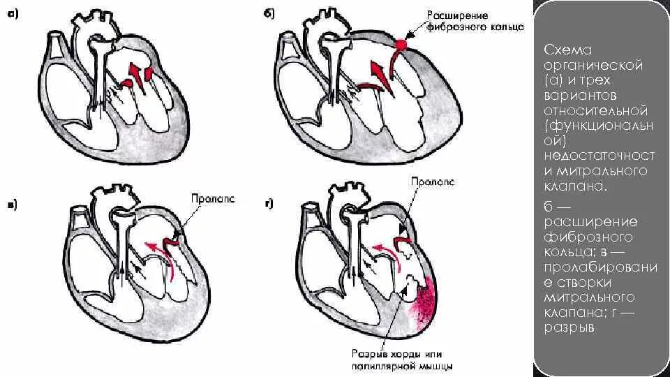 Приобретённые пороки сердца недостаточность митрального клапана. Стеноз митрального клапана гемодинамика схема. Приобретенные пороки сердца схема. Приобретенные митральные пороки сердца. Сердечная недостаточность митрального клапана