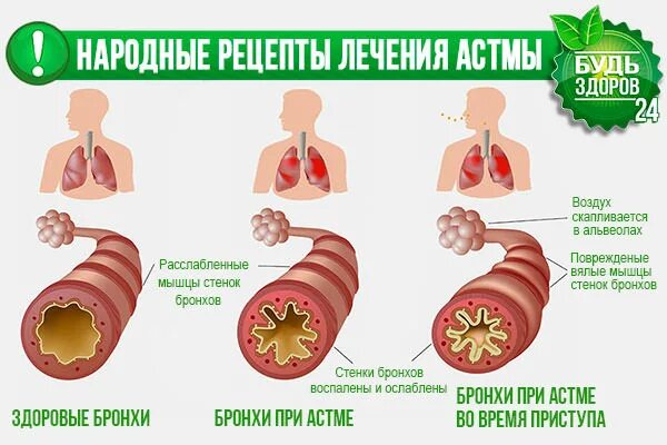 Чем лечить бронхиальную астму у взрослых. Аллергическая бронхиальная астма. Народные средства при бронхиальной астме. Бронхиальная астма излечивается. Бронхиальная астма народные средства.