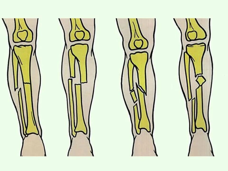Сколько заживает бедро. Перелом малой берцовой кости классификация. Перелом большеберцовой кости. Перелом большеберцовой кости гипс. Перелом большеберцовой кости клиника.