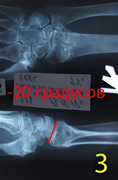Вторичное смещение при переломе