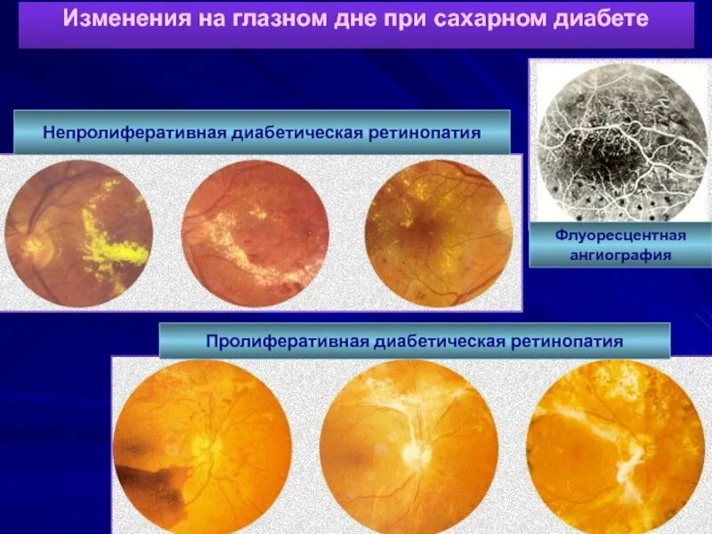 Непролиферативная диабетическая ретинопатия. Диабетическая ретинопатия глазное дно. Диабетическая микроангиопатия, ретинопатия, нефропатия.. Патанатомия диабетической ретинопатии.