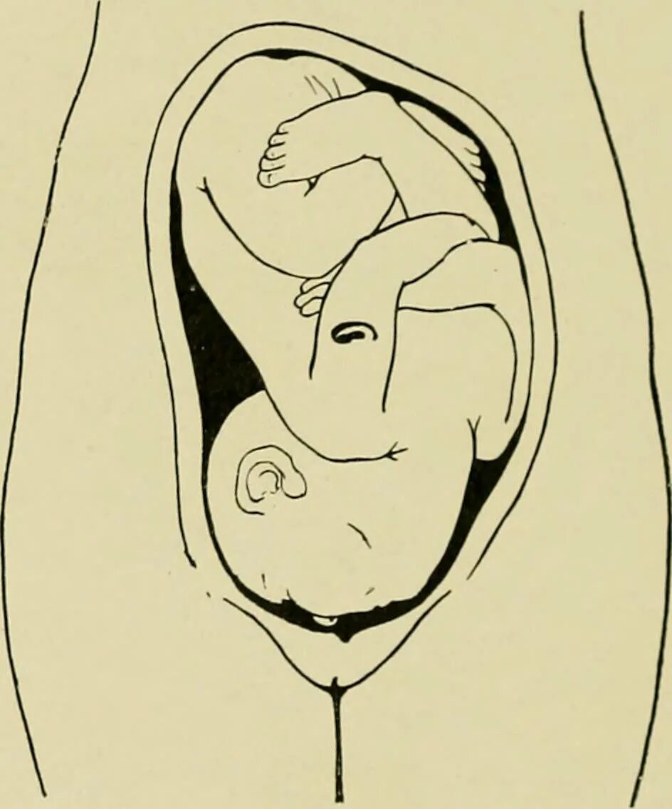 Ребенок расположен справа. Положение ребенка в животе. Положение ребенка в животе перед родами. Позиция ребёнка в жывоте. Положение ребенка на 30 неделе.