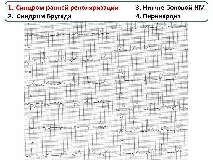 Нарушение процесса реполяризации желудочков в нижней стенке. Ранняя реполяризация на ЭКГ. Ранняя реполяризация желудочков сердца на ЭКГ. Ранняя реполяризация желудочков на ЭКГ. Синдром ранней реполяризации желудочков на ЭКГ.