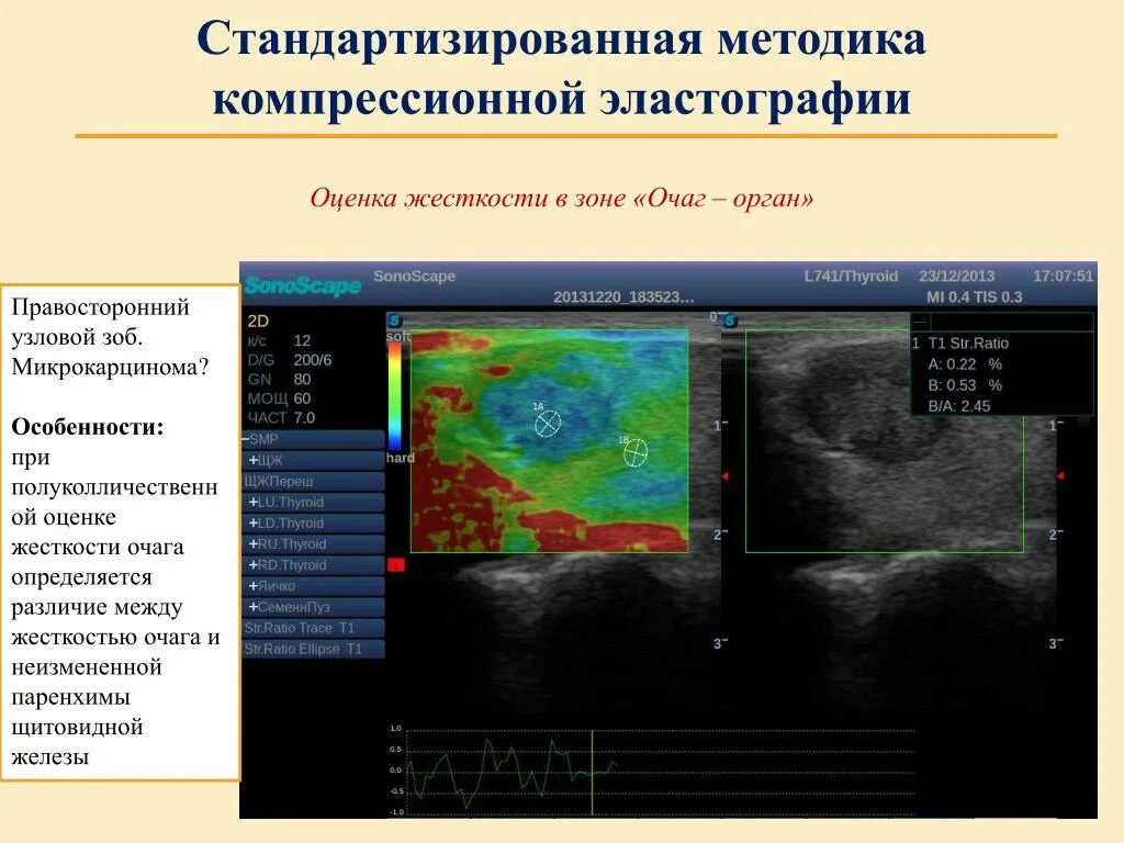 Эластография щитовидной железы что это. Эластография щитовидной железы протокол. Эластография щитовидной железы протокол УЗИ. Эластография щитовидной железы шкала. Эластография щитовидной железы что это такое.