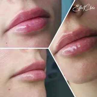 Увеличение губ татуажем