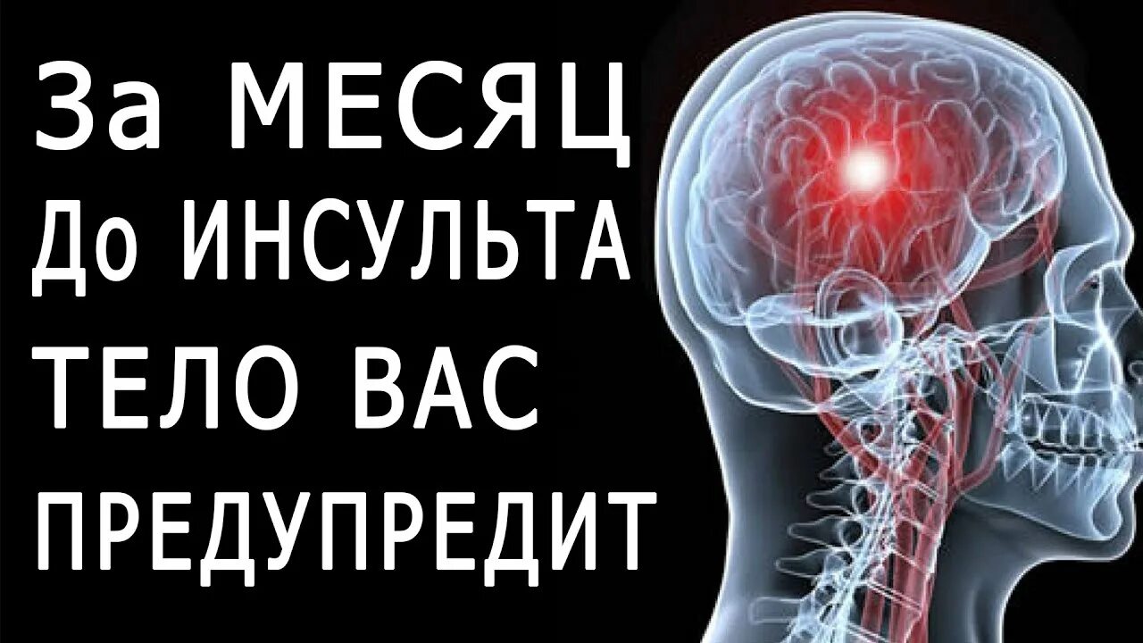 Инсульт. Организм предупреждает об инсульте. Признаки инсульта. Первые признаки инсульта.