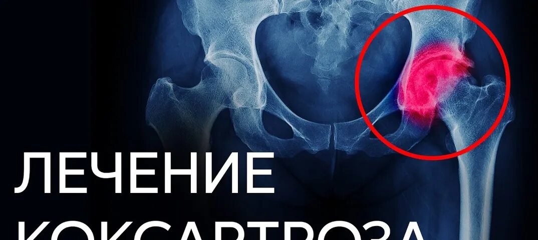 Коксартроз тазобедренного сустава таблетки обезболивающее. Коксартроза тазобедренного сустава. таблетки для коксартроза тазобедренного сустава. коксартроз тазобедренного сустава 3 степени операция.
