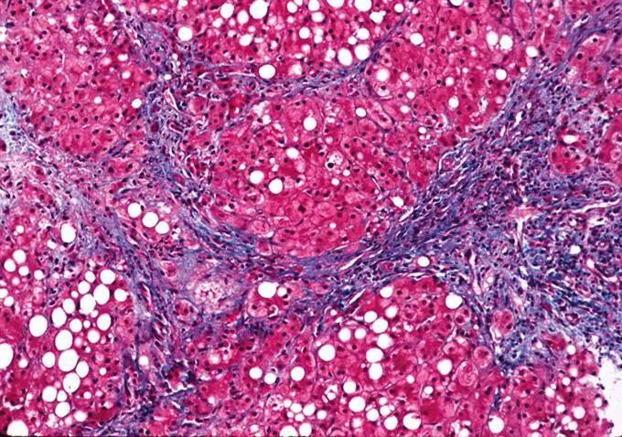 Фиброз гепатоз печени цирроз. Гепатит фиброз. Гепатит фиброз. Стадии хронического гепатита. Врожденный фиброз печени.