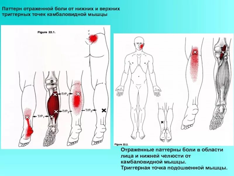 Триггерные точки это простыми словами. Карта триггерных точек икроножных мышц. Триггерные точки камбаловидной мышцы. Триггерные точки нижних конечностей. Триггерные точки мышц голени.