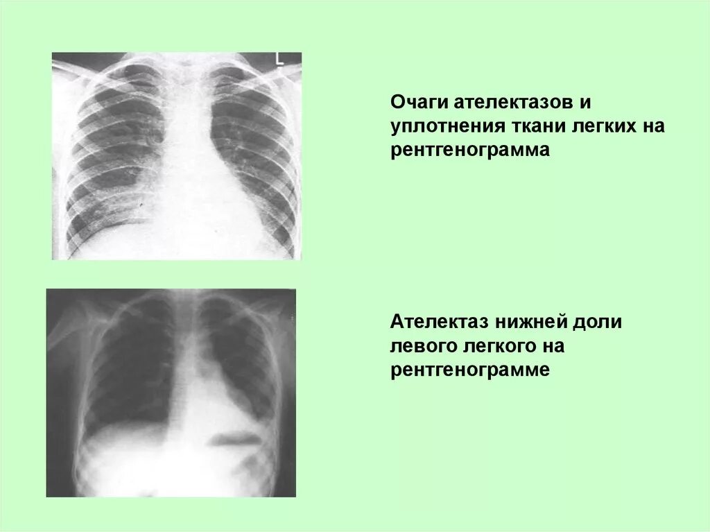 Уплотнение нижней доли легкого