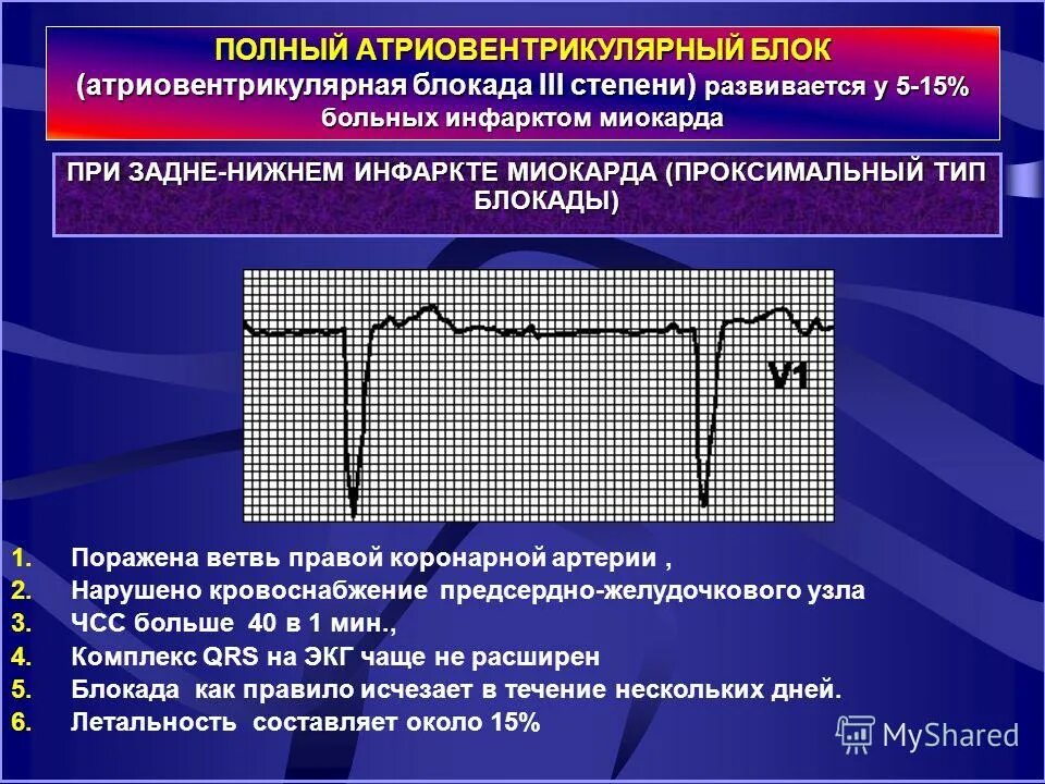 Полная атриовентрикулярная блокада. Атриовентрикулярная блокада при Нижнем инфаркте миокарда. Осложнение инфаркта миокарда АВ блокада. Атриовентрикулярная блокада III степени (полная АВ-блокада). 3 Степень атриовентрикулярной блокады.
