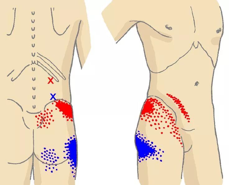 Отдает в пах слева у мужчин. Триггерные точки бедра. Тт1 триггерная точка. Триггерные точки бедра и спина. Боль в пояснице триггерные точки.