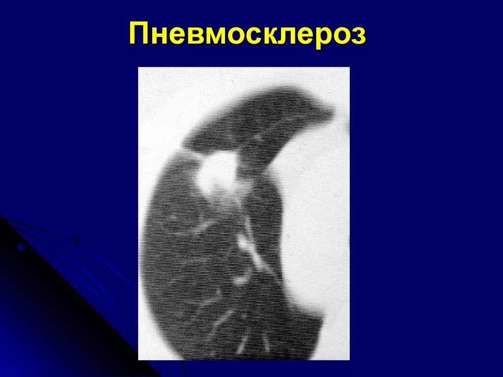 Пневмосклероз рентген. Диффузный пневмофиброз кт. Пневмосклероз легких кт. Пневмосклероз кт картина. Диффузная пневмосклероз у пожилых