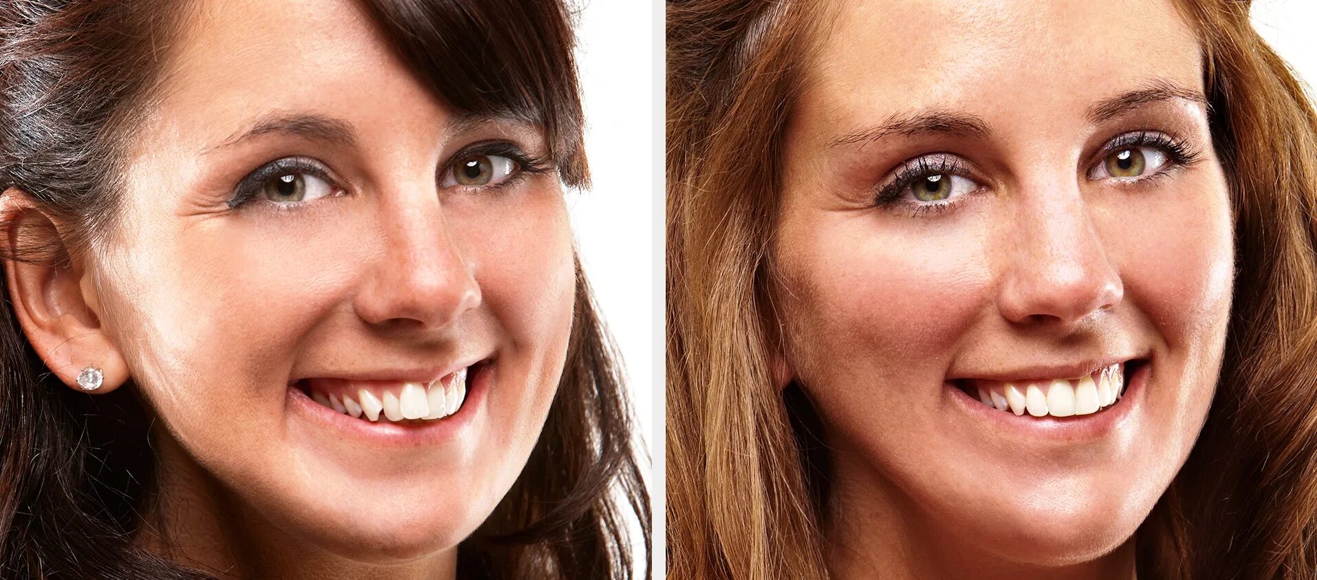 Зубы после 30. Улыбка с неправильным прикусом. Изменение прикуса до и после.