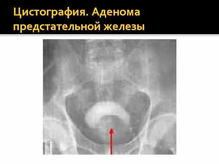 Гиперплазия предстательной железы рентген. Методом диагностики аденомы предстательной железы является. Подозрения на простату