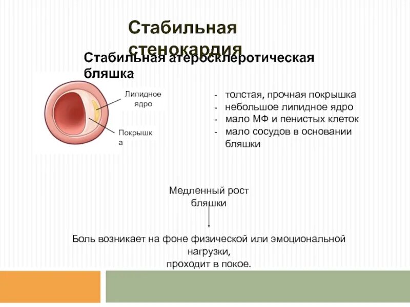 Самое стабильное ядро. Покрышка атеросклеротической бляшки. Липидное ядро атеросклеротической бляшки. Липидное ядро покрышка.