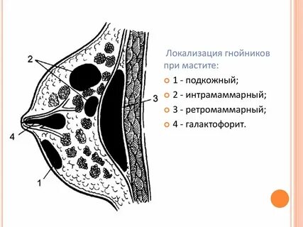 Что значит интрамаммарные лимфоузлы