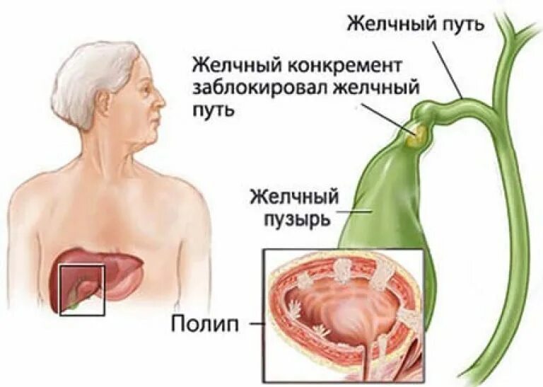 Что такое полип желчного пузыря. Полип желчного пузыря симптомы. полипоз желчного пузыря симптомы. полипы желчного пузыря классификация.