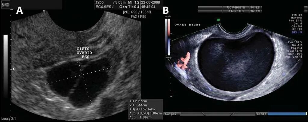 Узи признаки эндометриоза матки. Эндометриоидная киста на УЗИ. Эндометриоидные кисты яичников УЗИ. Эндометриоз яичника на УЗИ.