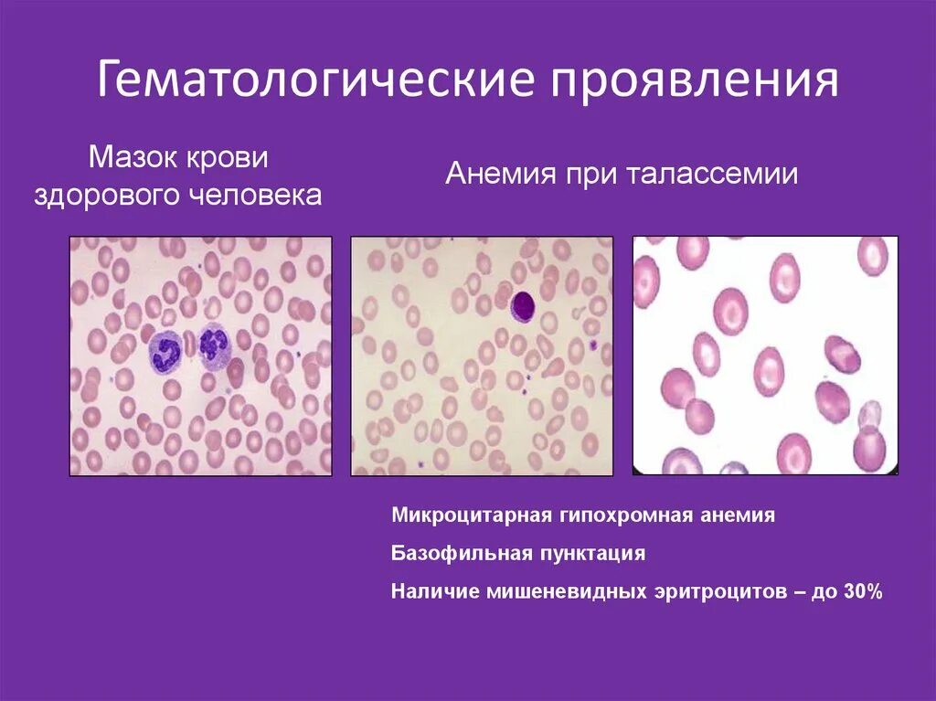 Мазок крови при выявлении патологии что это. Картина крови мазок при гипохромной анемии. Мазок крови при гемолитической анемии. Микроскопия мазка крови при гемолитической анемии. Талассемия анемия мазок крови.