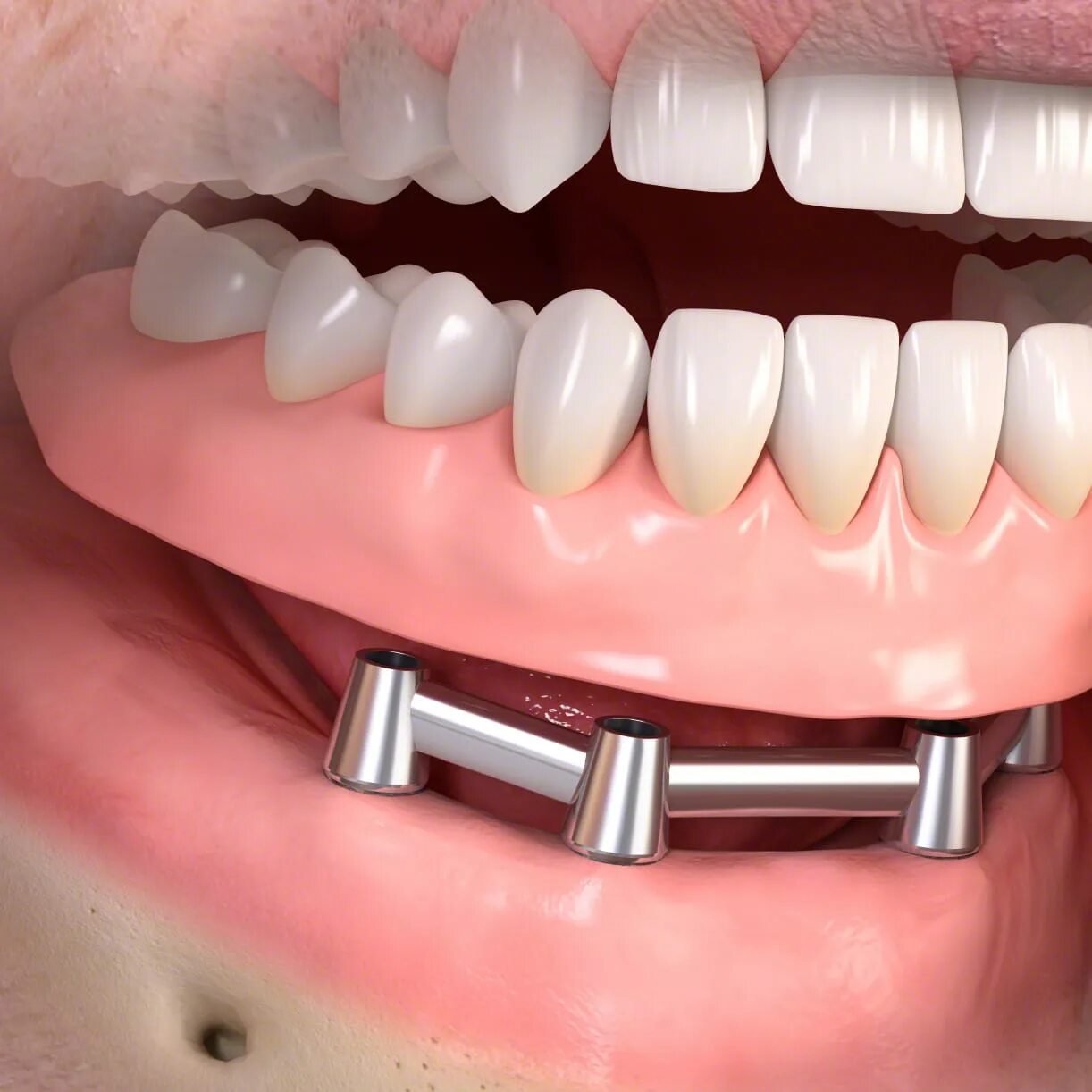 Несъемный мостовидный протез с опорой на 4 имплантата. Бюгельный мостовидный протез. Протез на 2 имплантатах на нижней челюсти. Мостовидные несъемные зубные. Мостовидный протез на имплантах на 4 зуба нижней челюсти.