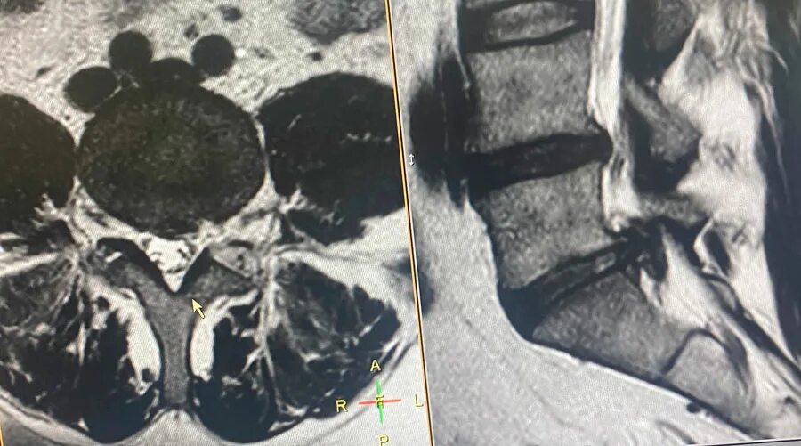 Грыжа диска l5 s1 что это. Оссифицирующий лигаментоз на кт. Микрохирургическое удаление грыжи диска l5. Кт мрт томограммы.