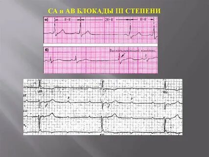 Степени са блокады