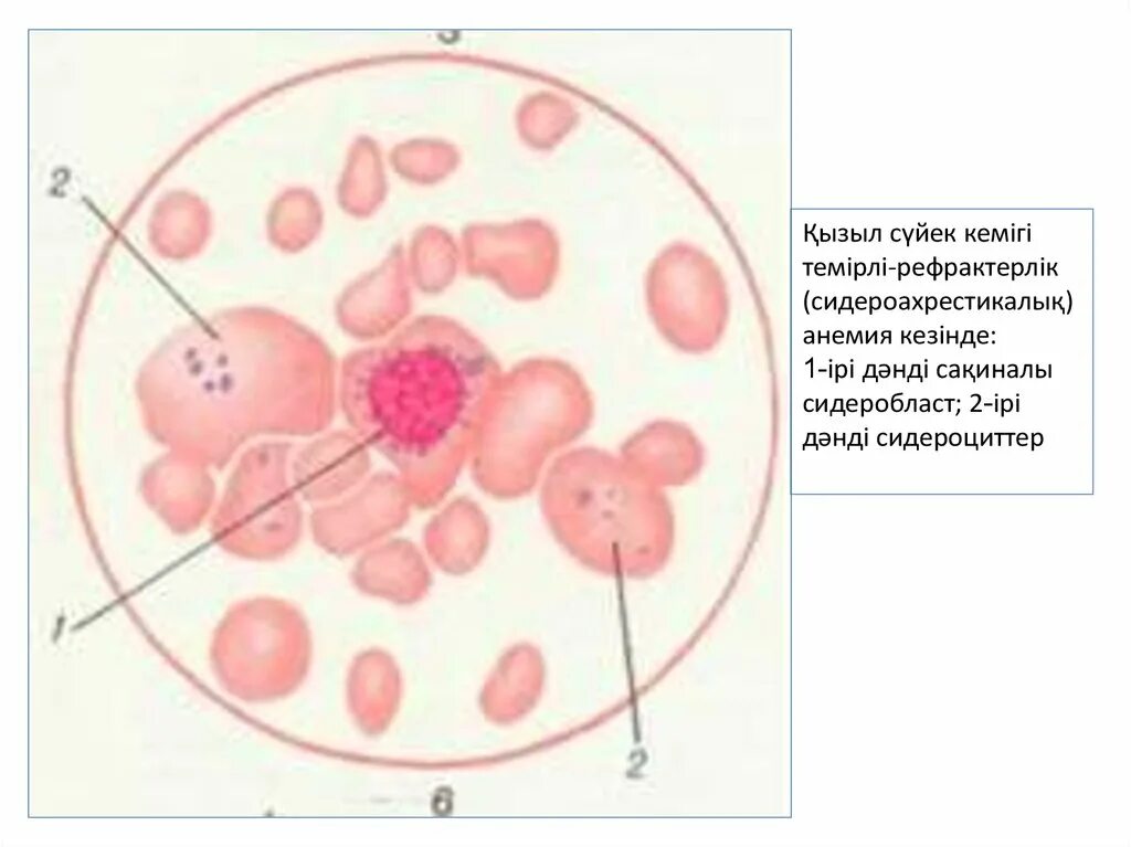 Пониженные макроциты. Сидероциты и сидеробласты. Сидеробласты в костном мозге. Кольцевидные сидеробласты. Сидеробластная анемия.