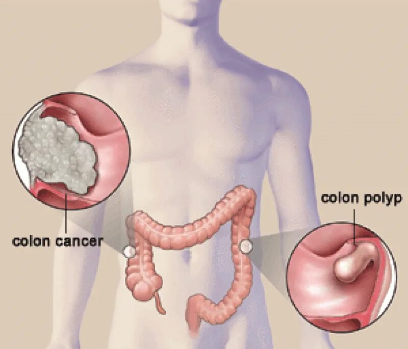 Симптомы рака кишки. Полипы в кишечнике симптомы. Полипы кишечника онкология. Злокачественный полип в прямой кишке.
