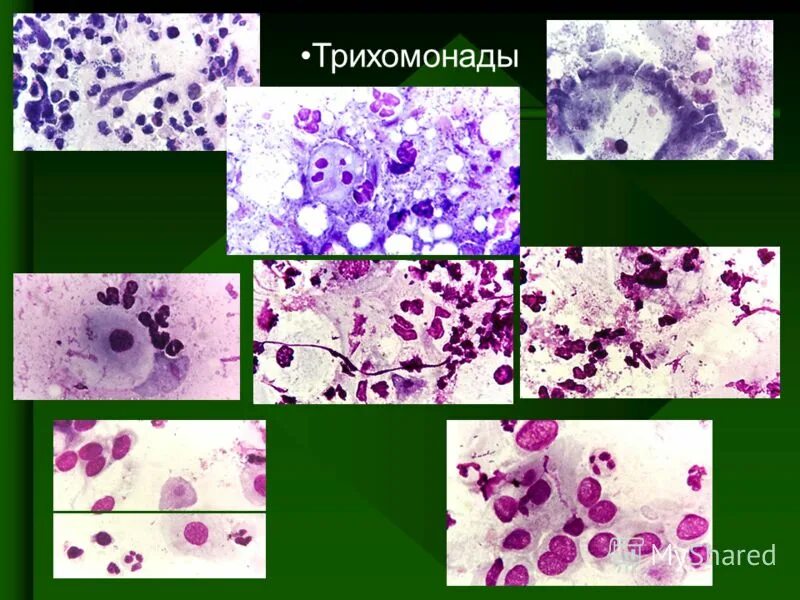 Трихомонада микробиология. Осложнения трихомониаза. Трихомоноз у мужчин симптомы