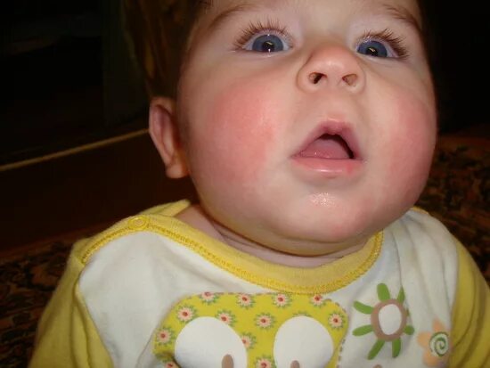 Ребенку год красные щеки. Красные щеки у грудничка. Аллергия красные щеки у ребенка. Аллергическое покраснение щечек у грудничка.