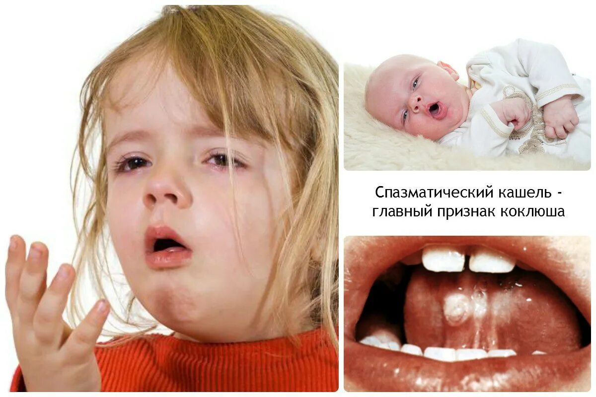 Беспокойный грудничок. Отёк мозга у новорожденного последствия. Коклюшеобразный кашель у детей. Ребенок кашляет. Коклюш грудной ребенок.
