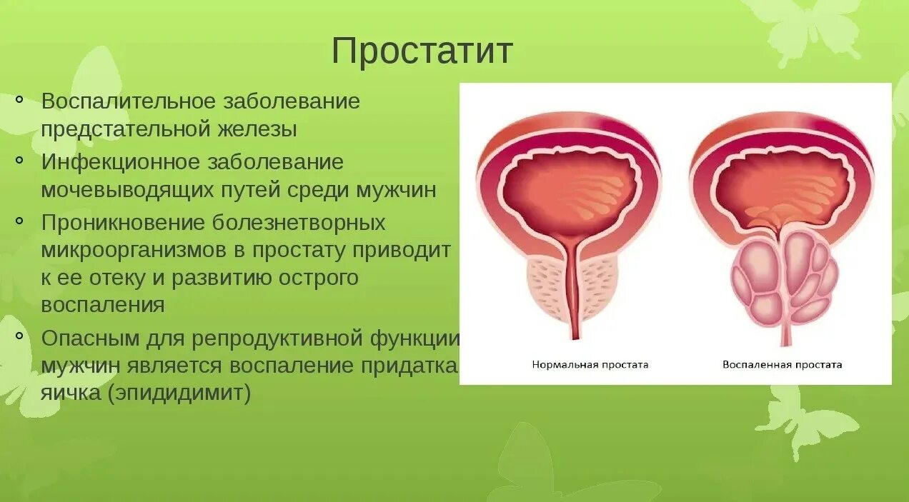 Заболевания предстательной железы. Патология предстательной железы. Патология предстательной железы у мужчин. Воспалительные заболевания предстательной железы. Нарушение предстательной железы